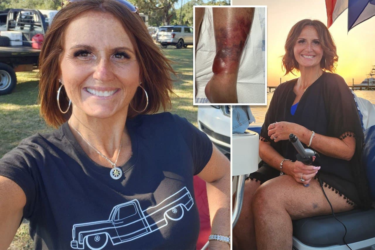 Woman Survives Flesh-Eating Bacteria After Florida Beach Swim
