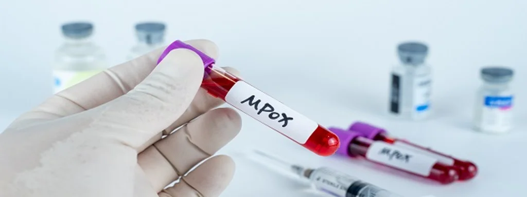 California reports first U.S. cases of potentially severe mpox strain