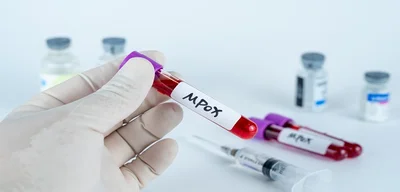 California reports first U.S. cases of potentially severe mpox strain