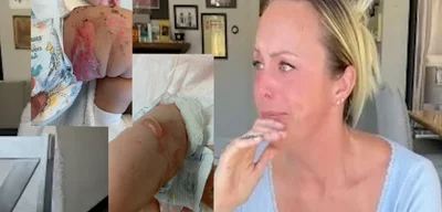 Mother Faces $100K Bill After Emergency Airlift for Burned Baby; Debt Resolved After Media Attention