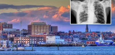 Rising Tuberculosis Cases in Maine Signal U.S. Health Crisis