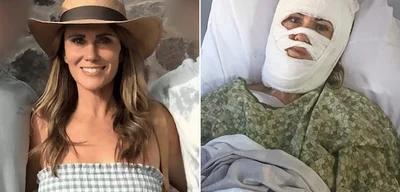 Georgia woman disfigured and facing millions in medical bills after acid attack