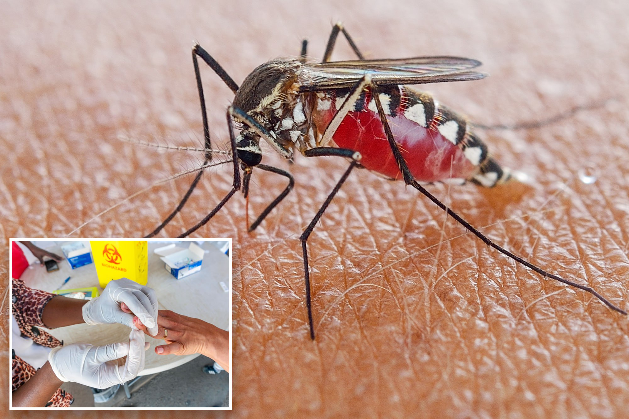 First Local Malaria Case in 27 Years Reported in New Jersey